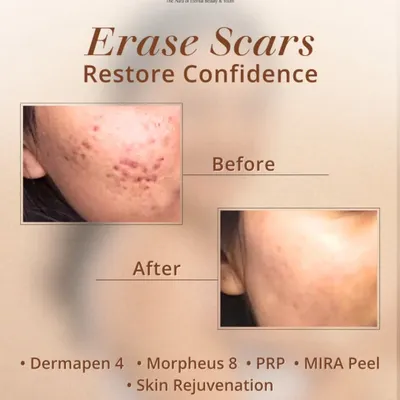 This before and after transformation shows the real results we can achieve for persistent acne scars. We use a combination of advanced treatments like Dermapen 4 microneedling, Morpheus 8, and specialized peels to resurface the skin, reduce scarring, and restore a smoother, more even complexion.