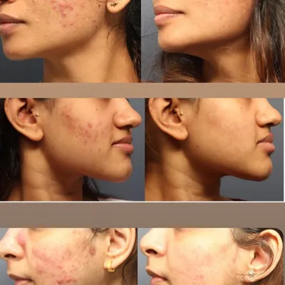 From Persistent Acne to Clear Confidence. These before-and-after images show the significant reduction in inflammatory acne and post-acne marks. A consistent, tailored regimen makes all the difference.