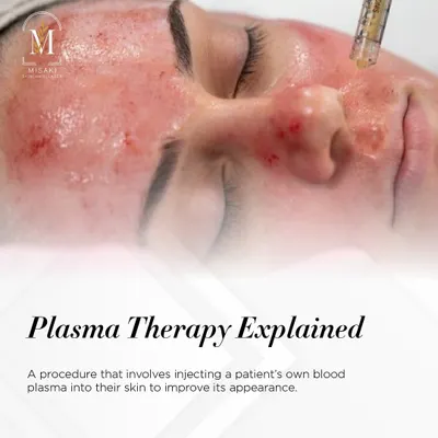 This image explains the basics of Plasma Therapy. While this shows a facial application, the principle is the same as in PRP for hair. We use your body's own plasma to rejuvenate and repair tissue, whether it's on your skin or scalp.
