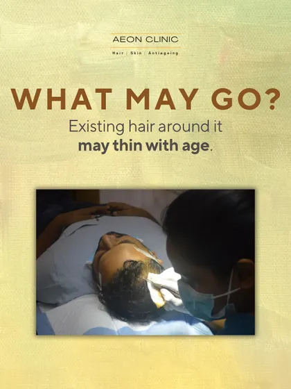 While transplanted hair is permanent, your existing, non-transplanted hair around it may continue to thin with age. This is why ongoing care is important.