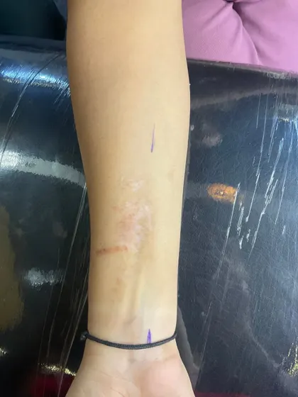 Before: A close-up of a scar on the client's wrist area, which they wanted to cover with a meaningful design.