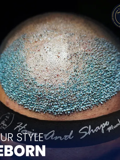 This is where science meets style. A detailed view of newly implanted hair follicles, showcasing the meticulous process of high-density hair restoration.