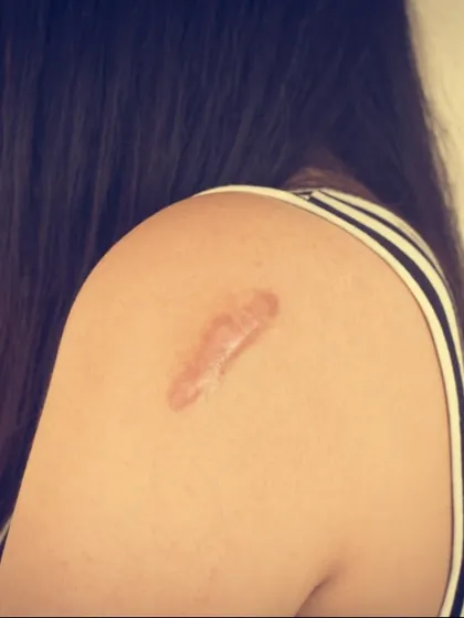 Scars from old injuries or surgeries can be a source of self-consciousness. I offer customized scar revision treatments designed to reduce their visibility and improve skin texture, helping you feel more confident in your appearance.