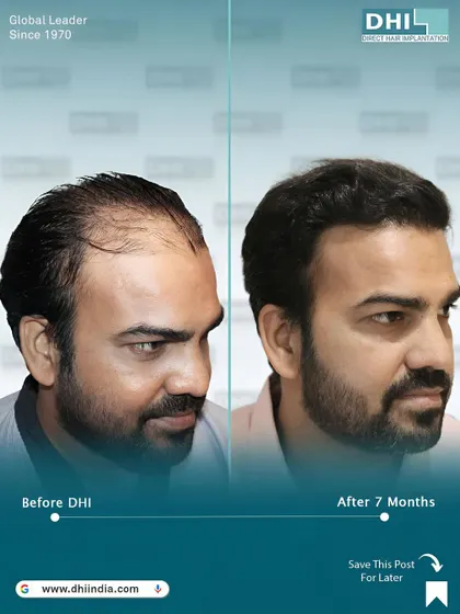 Another angle of the same client's 7-month transformation. This side view highlights the seamless integration of the transplanted hair with his existing hair, creating a completely natural look.