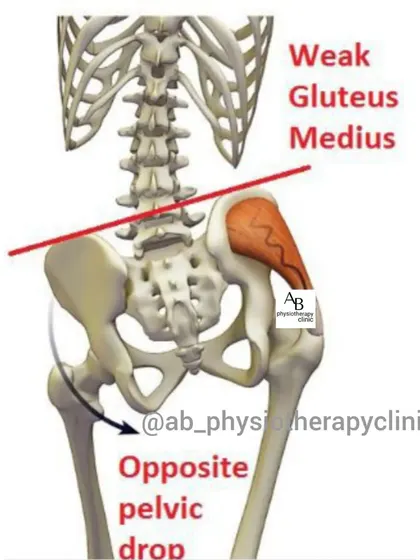 A weak gluteus medius muscle can cause the opposite side of your pelvis to drop, leading to an unstable gait and lower back pain. Strengthening this key hip muscle is often a critical part of my back pain treatment plans.