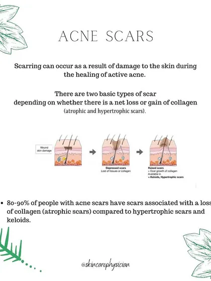 After active acne heals, it can leave behind scars. These are broadly categorized as atrophic (loss of collagen) or hypertrophic (gain of collagen).