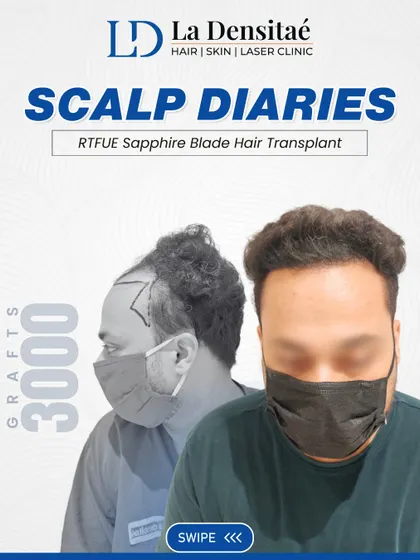 With 3,000 grafts using the RT-FUE Sapphire Blade Technique, Anurag got back his natural hair and his confidence. This technique allows for finer incisions, leading to faster healing and denser packing of grafts.