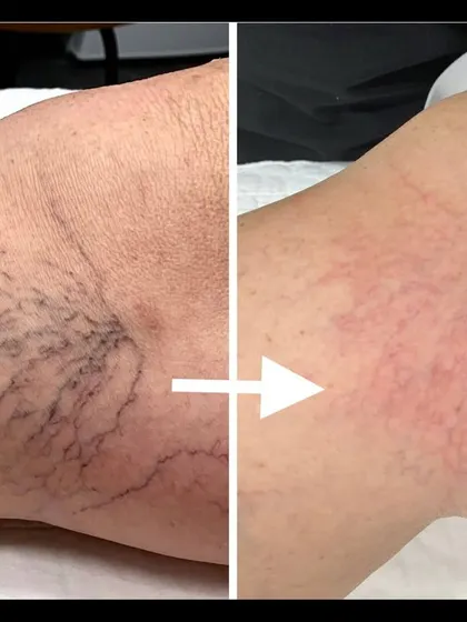 A clear result from microsclerotherapy for leg spider veins. This safe and effective treatment can help you feel more confident wearing shorts or skirts, freeing you from the need to cover up visible veins.