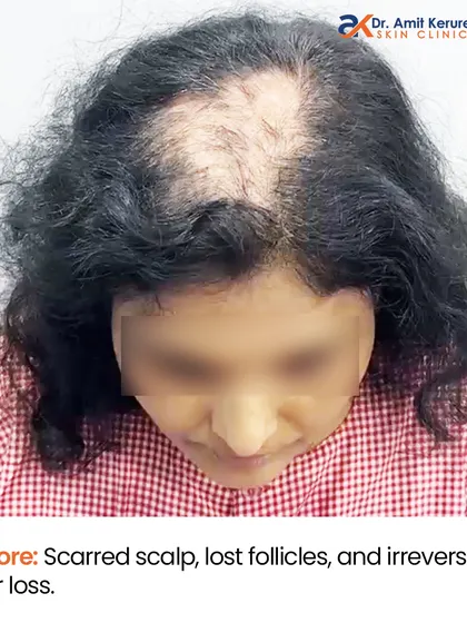This 'before' image shows a patient with a scarred scalp from Lichen Planopilaris. In this condition, hair follicles are irreversibly lost, and you can see the significant bald patch before our intervention.