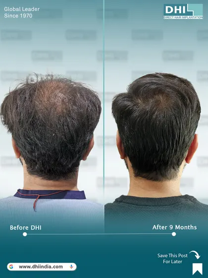 A rear view of the 9-month transformation, showing excellent coverage on the crown and back of the head. Our technique ensures a natural look from every angle.