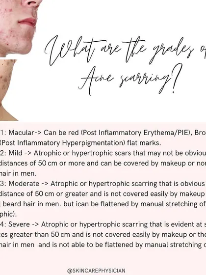 Acne scarring is graded based on severity, from flat marks to deep, noticeable scars. Understanding your grade helps us set realistic expectations and tailor a treatment plan that addresses your specific level of scarring.