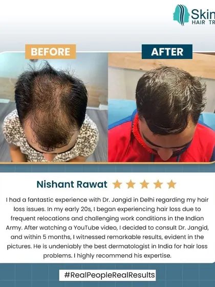 Real results speak louder than words. This is Nishant's story, who came to me with hair loss issues he faced while in the army. With a personalized non-surgical treatment plan, we achieved these remarkable results in just five months, significantly improving hair density and coverage.