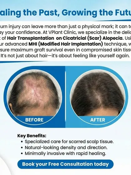 We specialize in complex cases, including hair transplantation on scar tissue (Cicatricial Alopecia). This before-and-after result shows how our advanced MHI technique can successfully restore hair even on skin compromised by a burn injury, helping clients feel whole again.