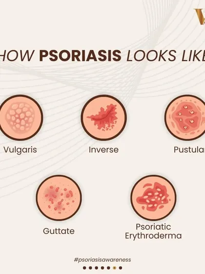 This infographic illustrates the different types of psoriasis, including Vulgaris, Inverse, Pustular, Guttate, and Psoriatic Erythroderma. Each type looks different and may require a unique treatment approach, emphasizing the need for an expert diagnosis.