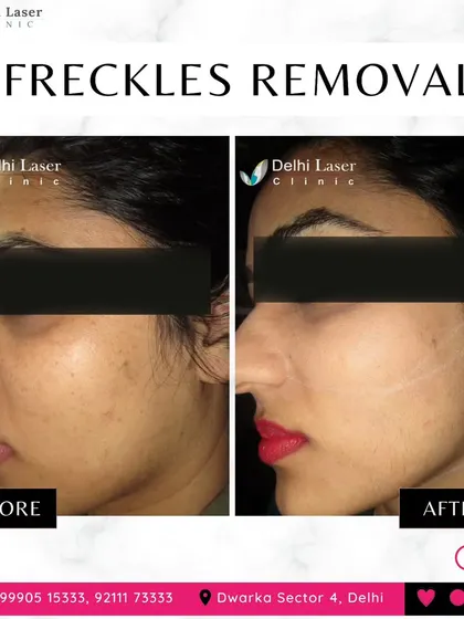 Freckles and sun spots can be effectively lightened with our Medlite C6 Q-Switch laser. This before-and-after shows a visible reduction in freckles, leading to a clearer and more uniform complexion.