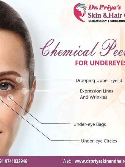 A chemical peel for the undereyes can address multiple concerns at once. It is effective for drooping upper eyelids, expression lines, under-eye bags, and dark circles.