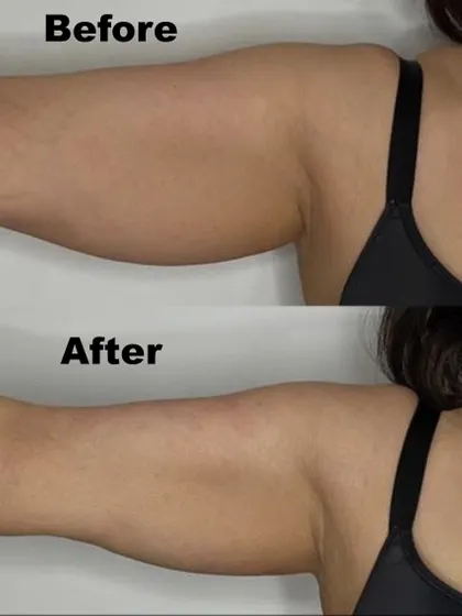 Another example of our successful arm tightening procedure. We help clients achieve smoother, more toned-looking arms without surgery.