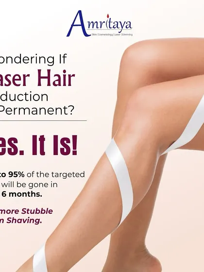 Is laser hair reduction permanent? Yes, it is! With our treatment plan, you can expect up to 95% of targeted hair to be gone in 5 to 6 months, eliminating stubble from shaving for good.