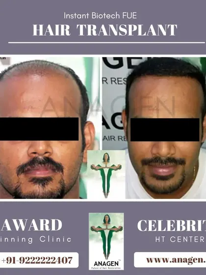 An amazing result from our Instant Biotech FUE hair transplant. This before and after photo shows a significant improvement in hair density and coverage.