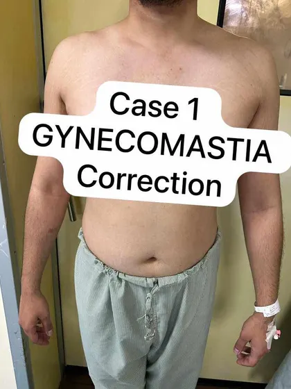 A straightforward before image of a patient scheduled for gynecomastia correction, labeled as Case 1. This serves as a clear starting point to understand the patient's initial condition.