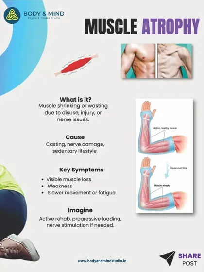 This graphic explains muscle atrophy, which is the shrinking of muscle due to disuse or injury. Active rehabilitation and progressive loading, as used in my practice, are key to reversing it.