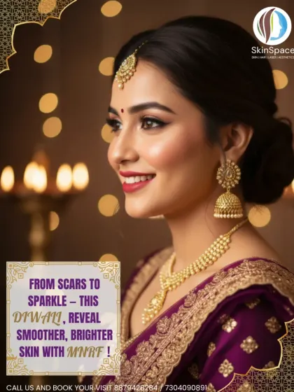 Microneedling RF (MNRF) is an excellent treatment to prepare for a special occasion. It works over time to reduce acne scars and open pores, revealing a smoother and more radiant complexion just in time for you to shine.