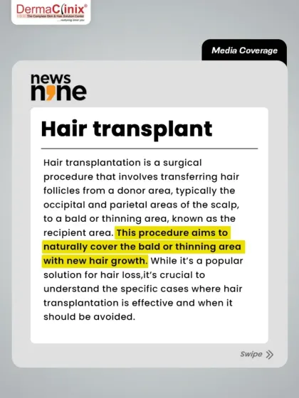This article explains the basics of a hair transplant, a surgical procedure that transfers hair follicles to a bald or thinning area. It is crucial to understand when this procedure is effective and when it should be avoided.