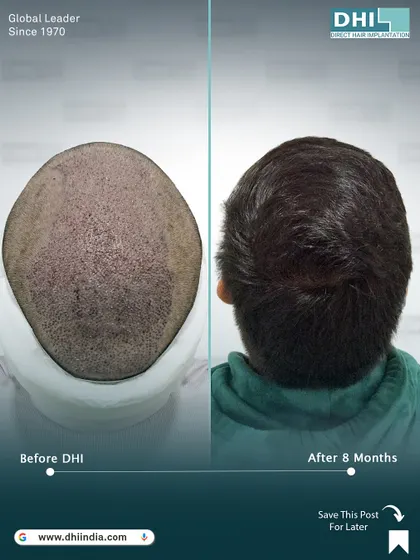 A before and after of the crown area 8 months post-transplant. This image shows the incredible density achieved for a patient with Atypical Andro Genetic Alopecia after implanting 7,612 hairs.