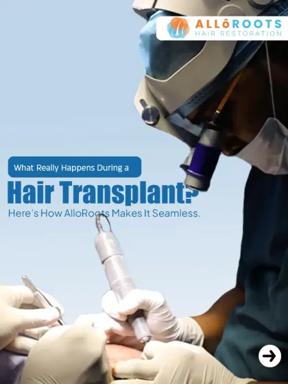 This image shows the FUE procedure in action. I handle the critical steps myself, using magnification and precision tools to extract and implant each graft, ensuring the highest standards of quality and care.