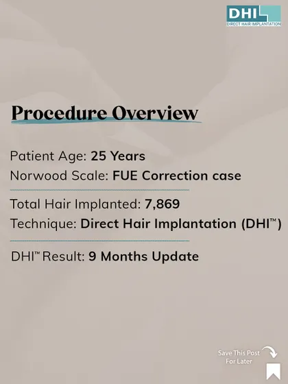 This card provides an overview of the corrective procedure for the 25-year-old patient. It details the total hair implanted (7,869) and the DHI technique used to achieve the successful 9-month update, turning a failed FUE into a success.