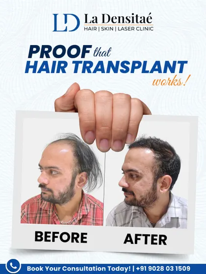 Unmesh Thatte was watching his hairline and confidence fade. He decided to take charge. This before-and-after shot shows the result of that decision, a natural look that reminds us real change starts with the first step.