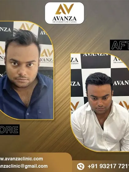 From thin to thick, this transformation showcases the effectiveness of our hair transplant procedure in restoring volume and confidence.