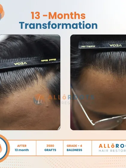 This 13-month transformation of a Grade 4 baldness case was achieved with 3500 grafts. Notice the natural density and the restored hairline from all angles, including a close-up view of the new hair growth.
