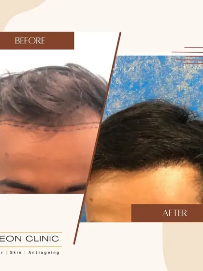 Another successful hairline and frontal region transplant. The after photo shows a natural, dense result that looks completely authentic.