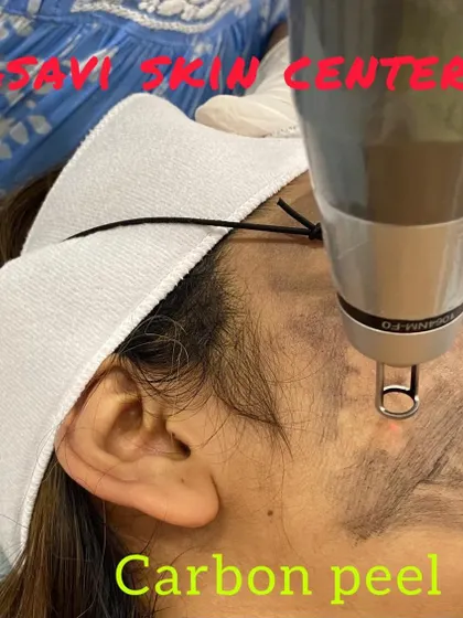A close-up view of the Carbon Peel treatment. A layer of liquid carbon is applied to the skin, which penetrates deep into the pores. The laser is then used to vaporize the carbon particles, taking dead skin cells, contaminants, and oil with it.
