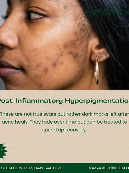 Post-Inflammatory Hyperpigmentation (PIH) appears as dark marks left after acne heals. While not true scars, as they don't affect skin texture, these spots can be persistent. I offer treatments to speed up their fading and restore an even skin tone.
