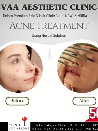 Before and after results for our acne treatment using a herbal solution, with a 50% off offer.