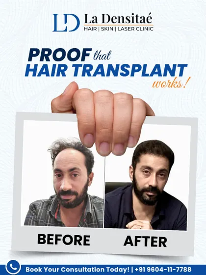 Here is more proof that hair transplants work. This incredible before-and-after transformation brought back not just hair, but a renewed sense of confidence. With the right care and expertise, these are the results you can expect.