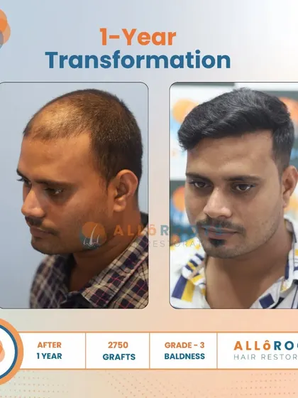 This one-year transformation for a Grade 3 baldness case was achieved with 2750 grafts. The series of photos demonstrates the significant improvement in density and hairline from every angle.
