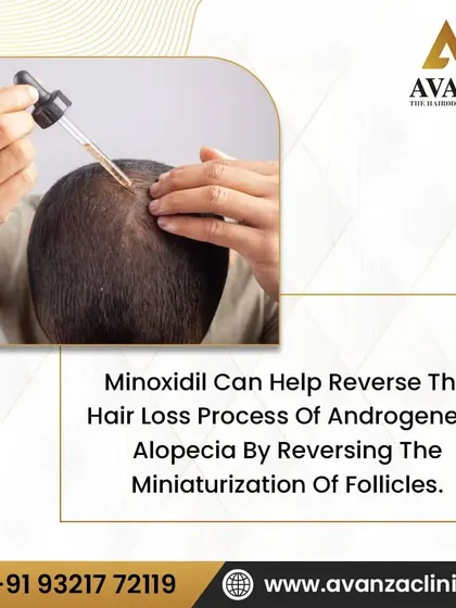 Minoxidil is particularly effective for androgenetic alopecia, or pattern baldness. It helps reverse the miniaturization of follicles, a process where hairs become progressively smaller and finer, allowing them to grow thicker and stronger again.