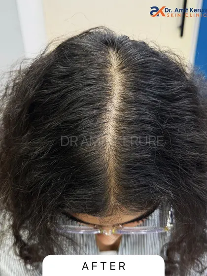 This is the 'after' photo for the same patient. You can see a dramatic reduction in the scalp visibility and a much denser, healthier appearance of the hair after completing a course of non-surgical treatment.