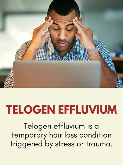 Telogen Effluvium is a temporary hair loss condition triggered by significant stress or trauma. It causes a large number of hairs to enter the shedding phase at once.