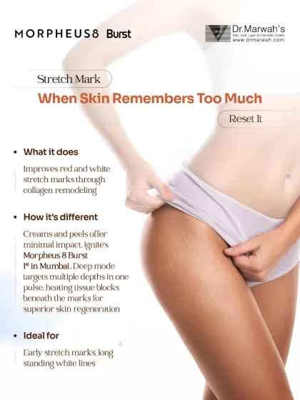 Stretch marks occur when the skin's structure is compromised, and topical creams often provide minimal improvement. I use Morpheus8 Burst, a deep-mode radiofrequency technology, to remodel collagen and improve the texture of both red and white stretch marks by targeting multiple skin depths in a single pulse.