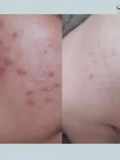 This transformation showcases the reduction of both active acne and post-inflammatory marks. My approach combines multiple technologies to not only clear breakouts but also to repair the skin's surface for a smoother finish.