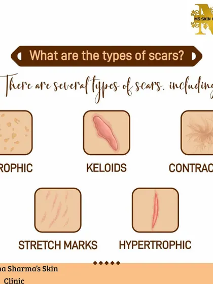 This infographic explains the different types of scars I treat, including atrophic, keloids, contracture, stretch marks, and hypertrophic scars. Understanding your scar type is the first step toward effective treatment.