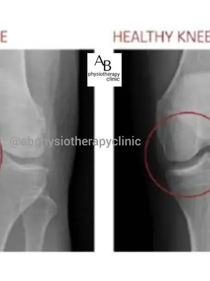 This X-ray comparison clearly shows the difference between a healthy knee joint and one affected by arthritis. You can see the reduced joint space, which is a common cause of pain, stiffness, and reduced mobility that we treat.