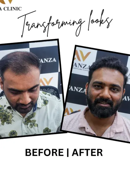 A fantastic transformation that not only restored his hair but also enhanced his overall look with a fuller beard. The result is a sharper, more confident appearance.