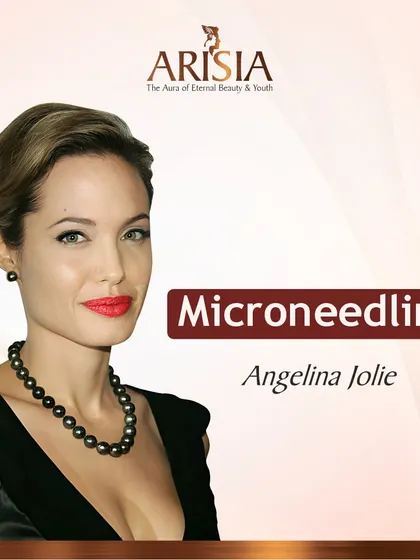 Microneedling is a favorite of stars like Angelina Jolie for maintaining flawless skin. It's an excellent method for treating acne scars and stimulating collagen for a healthy, youthful complexion.