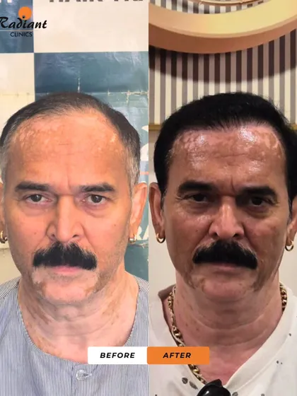 A frontal view of the same patient as image 24. The new hairline is designed to look natural and complements his facial features, completely transforming his appearance.