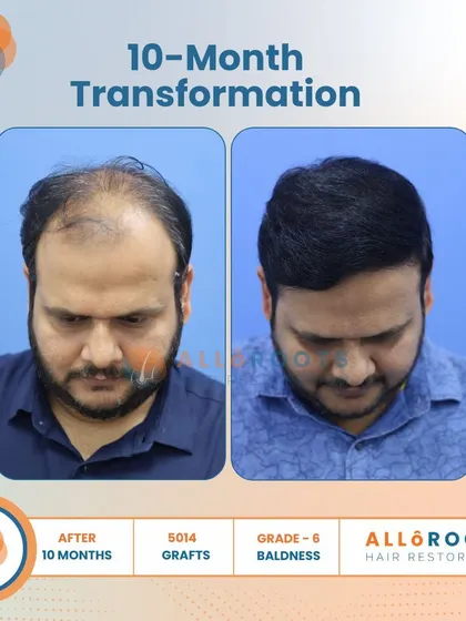 This 10-month transformation is a powerful example of tackling advanced Grade 6 baldness. With 5014 grafts, we achieved remarkable coverage and density, as seen from all angles.